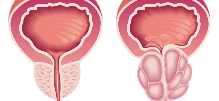 La_prostate_hyperplasie%20VitalHealth-Tao%20VirilHealth